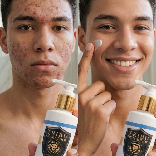 Gel Antiacné de Aloe Vera